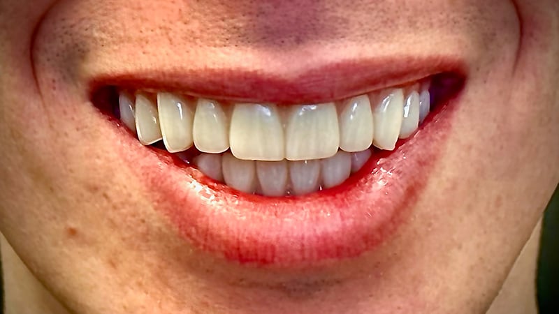 After full mouth reconstruction case 5