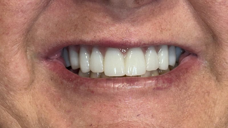 After full mouth reconstruction case 4