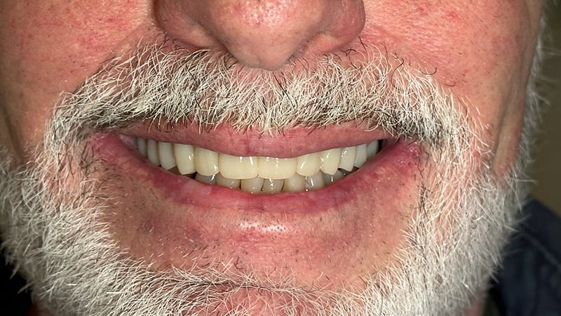 After full mouth reconstruction case 3