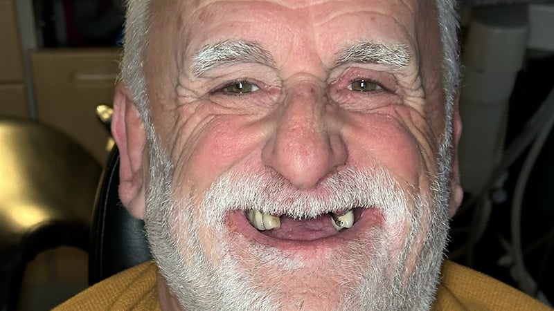 Before full mouth reconstruction case 2