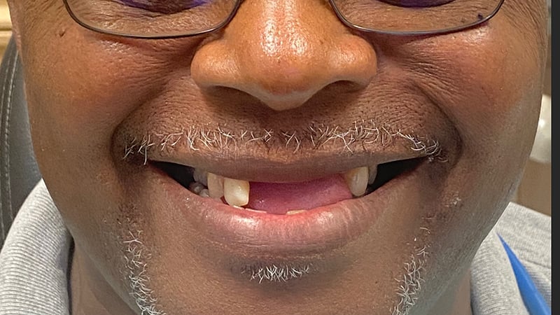 Before full mouth reconstruction case 1