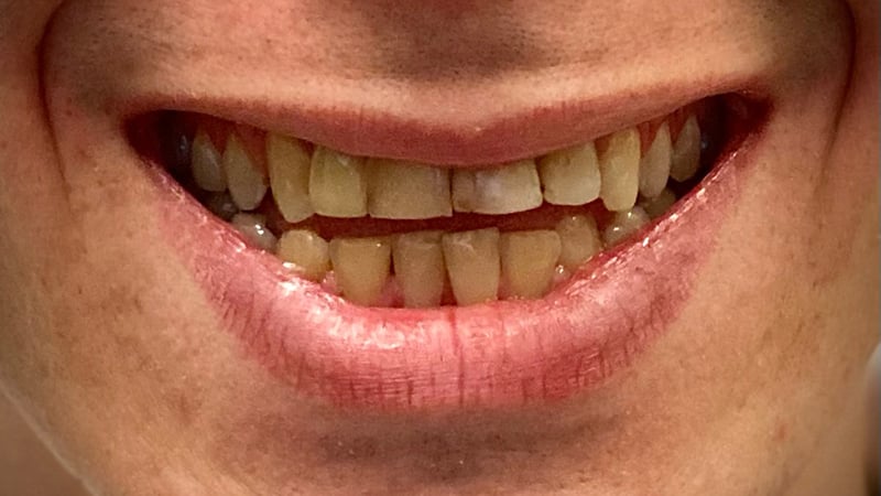 Before full mouth reconstruction case 5
