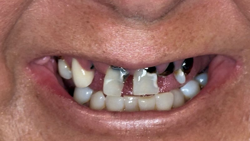 Before full mouth reconstruction case 4