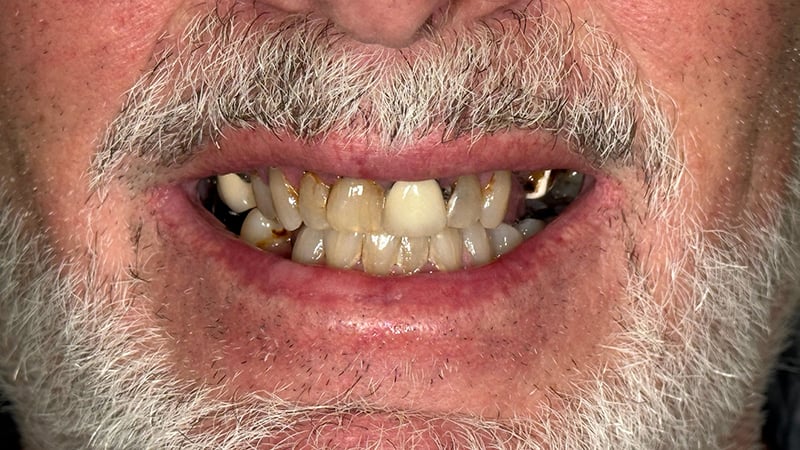 Before full mouth reconstruction case 3